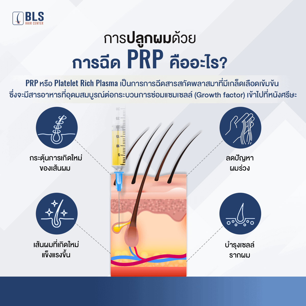 การปลูกผมด้วยการฉีด PRP คืออะไร?