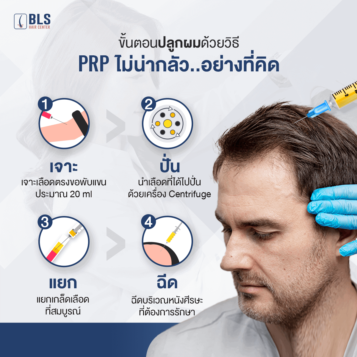 ขั้นตอนปลูกผมด้วยวิธี PRP ไม่น่ากลัวอย่างที่คิด