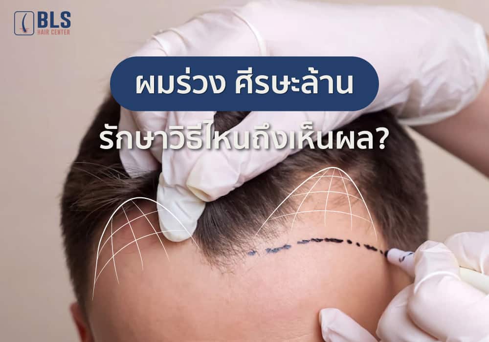 ผมร่วง ศีรษะล้าน รักษาวิธีไหนถึงเห็นผล?