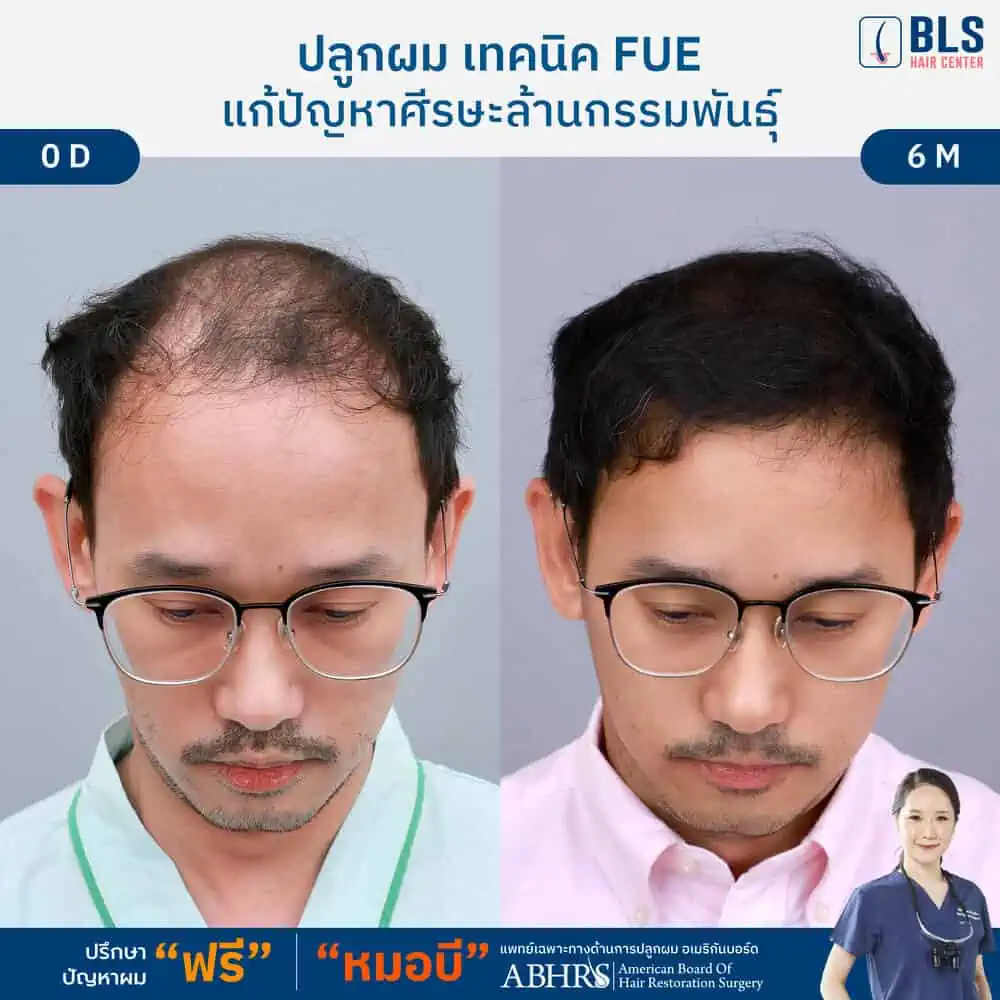 Review ปลูกผม Follicular Unit Extraction (FUE)