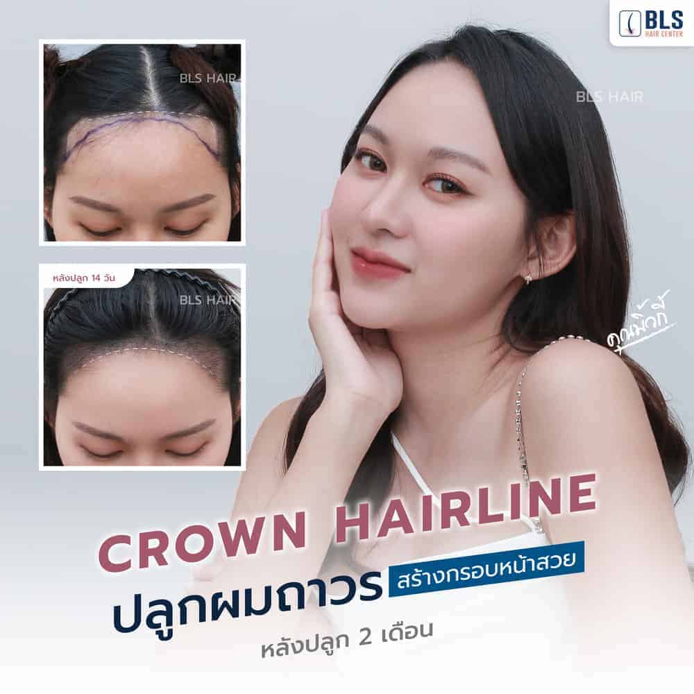 Review Female Hairline