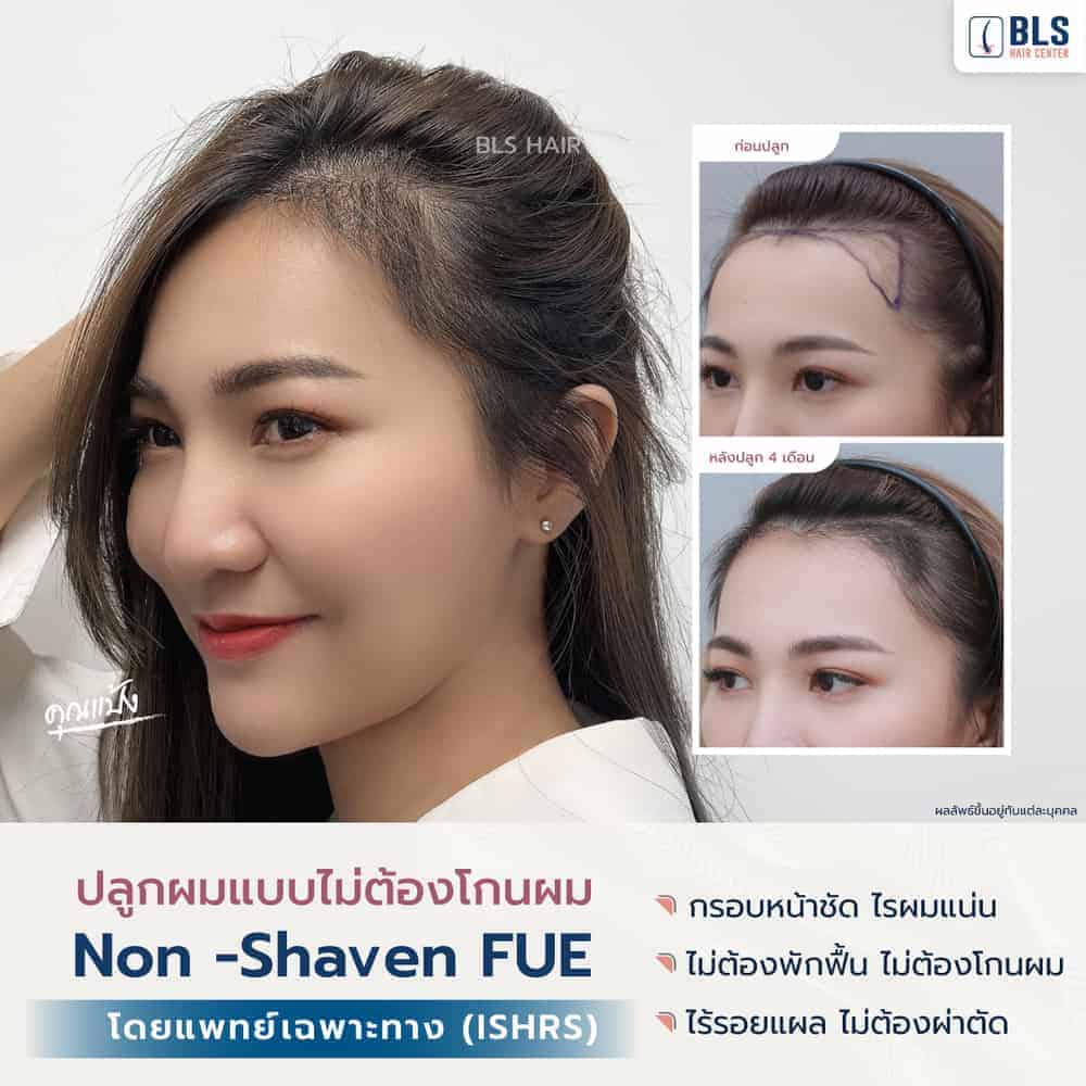 Review Non Shaven FUE