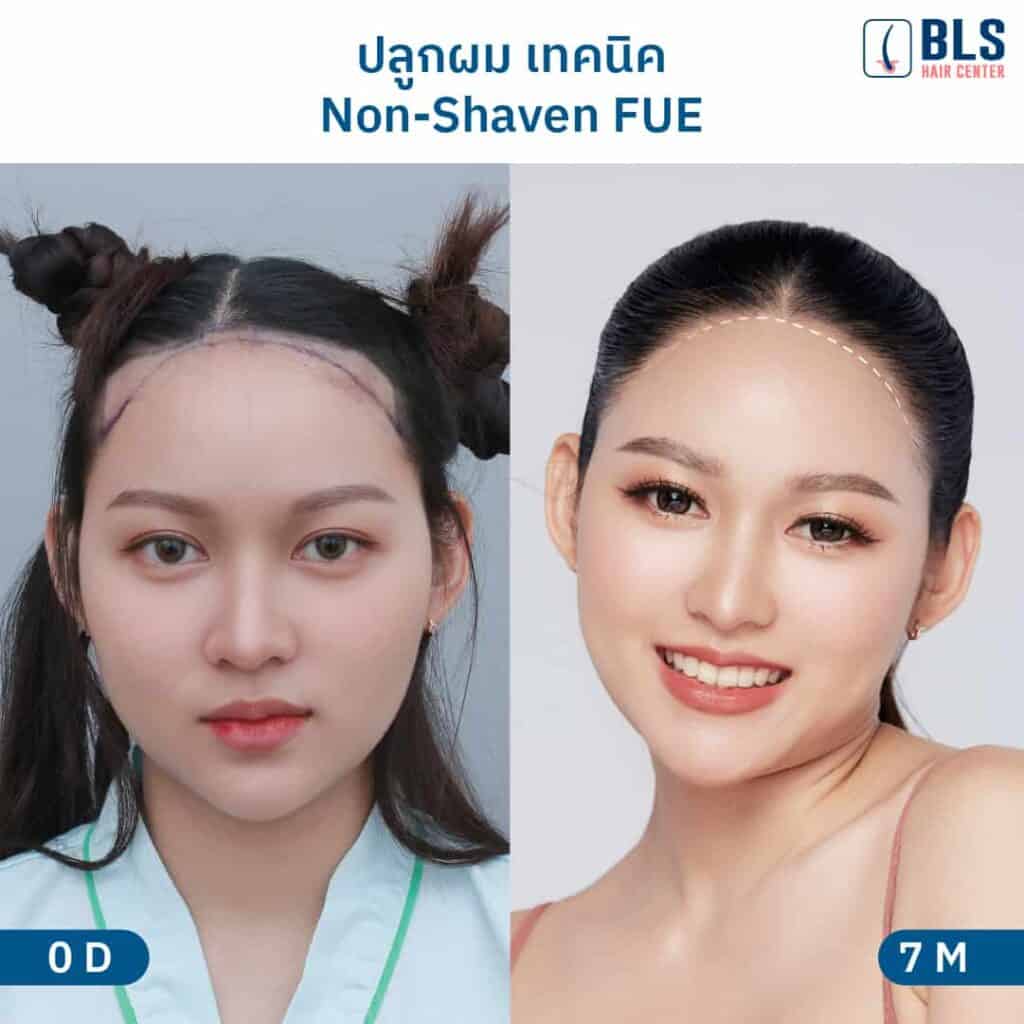 ชมเคส ปลูกผมผู้หญิง กรอบหน้าเป๊ะ แนวผมธรรมชาติ ที่ BLS Hair Center