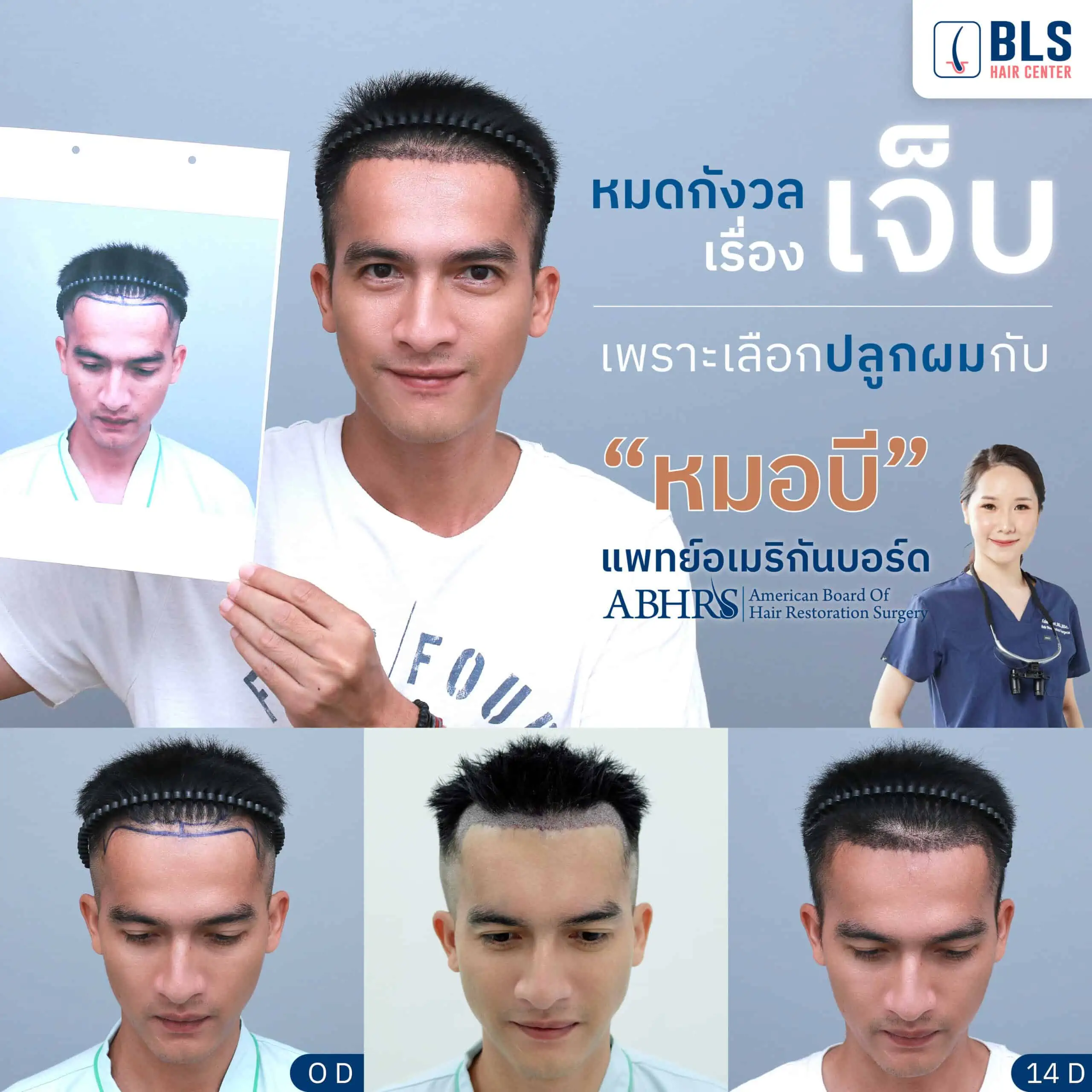 Review ปลูกผม Follicular Unit Extraction (FUE)