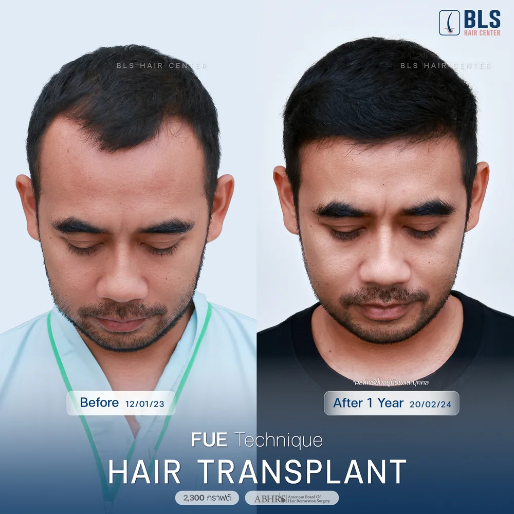 Hair Transplant FUE Technique 1 Year
