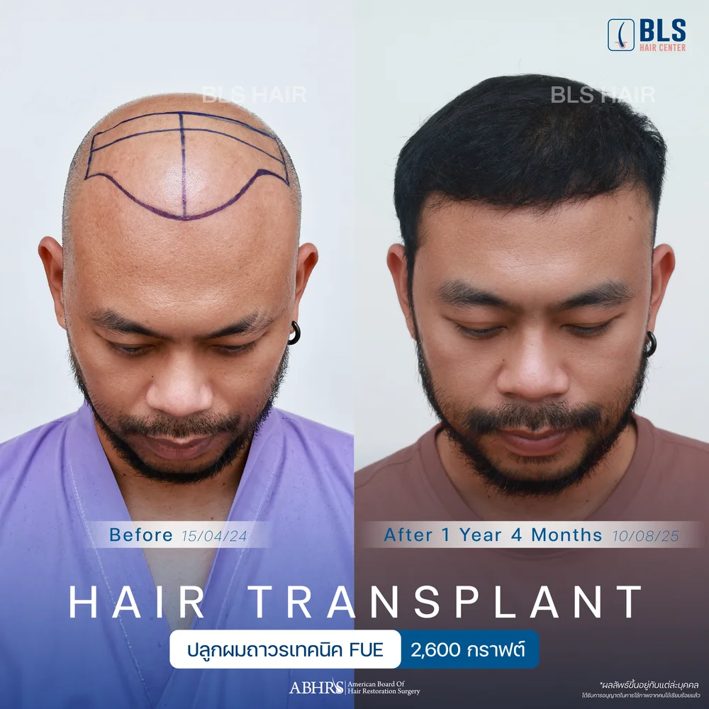 Hair Transplant FUE Technique