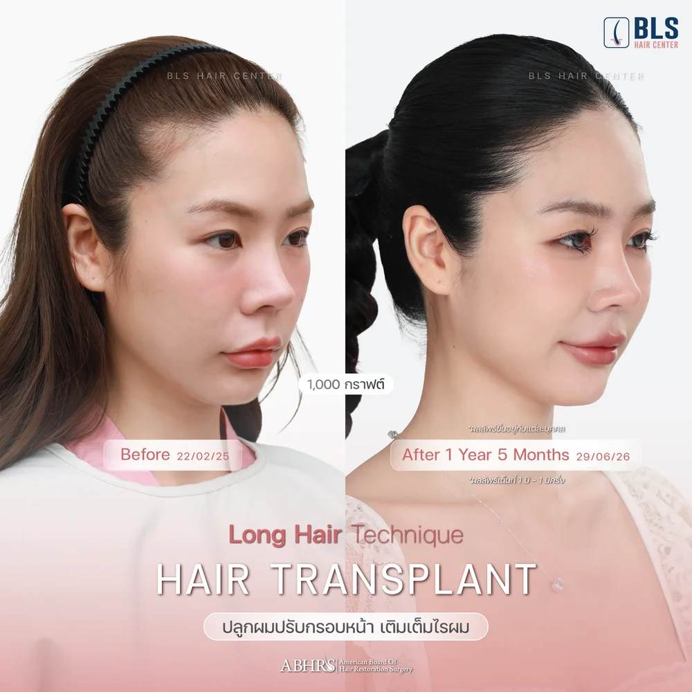 Hair Transplant at BLS Hair Center
