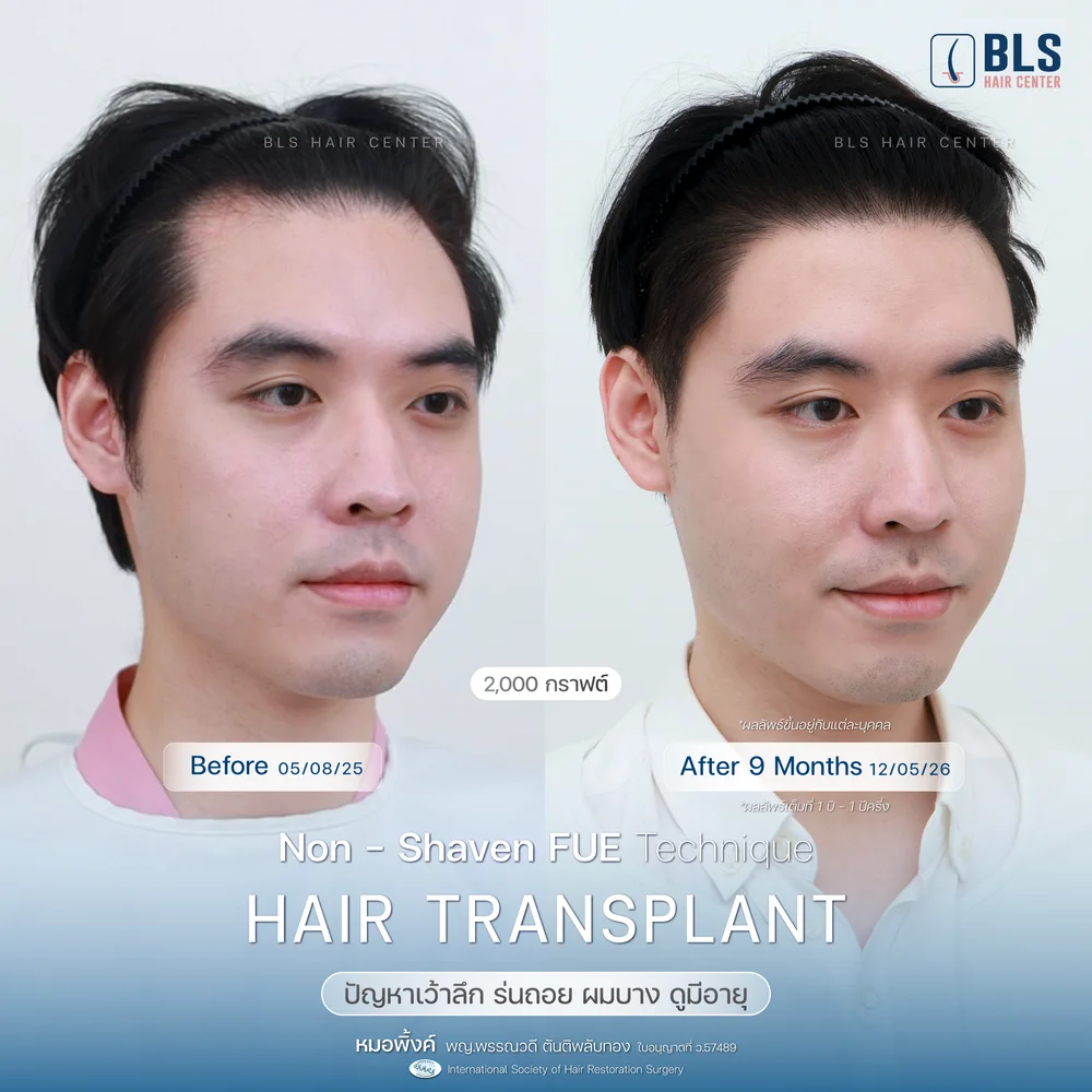 Hair Transplant at BLS Hair Center