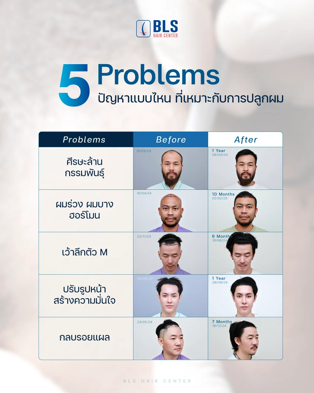 5 Hair Problems That Can Be Treated with a Hair Transplant