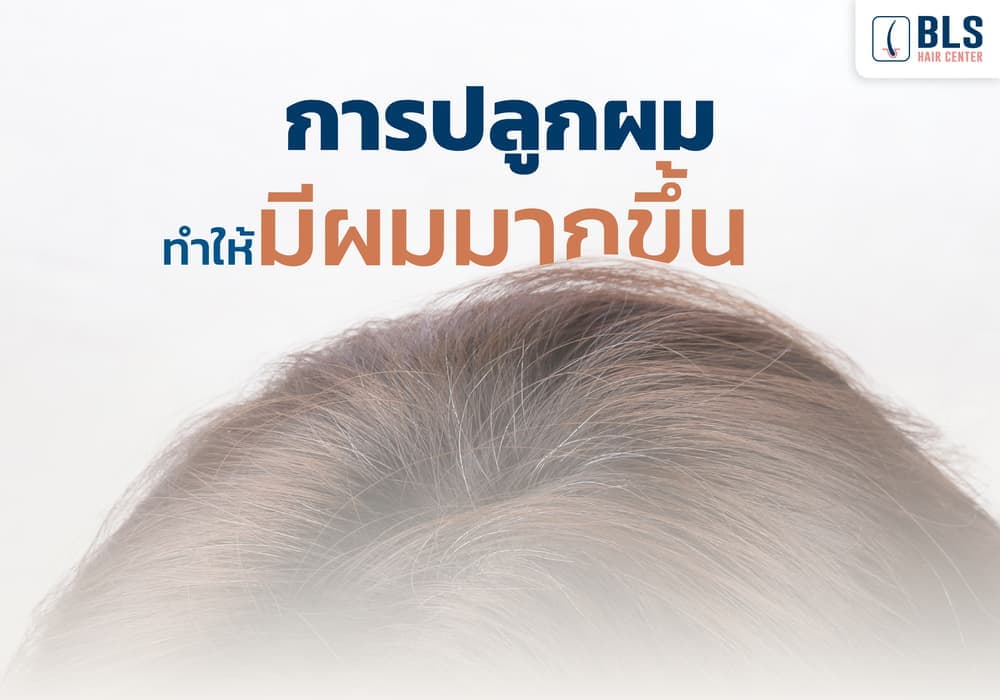 การปลูกผมทำให้มีผมมากขึ้น