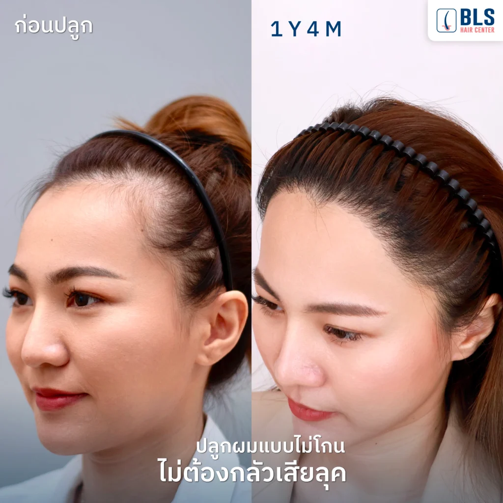 หลังปลูกผมผู้หญิง ด้วยเทคนิค Non-Shaven FUE ครบ 1 ปี