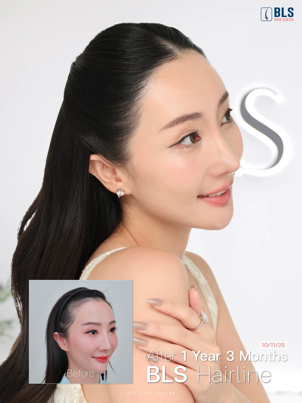 BLS Hairline ไรผมเป็นธรรมชาติ หลังปลูกผม Non-Shaven FUE