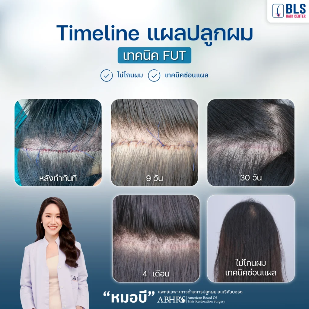 Timeline การเข้าที่ของแผลด้านหลังของเทคนิคปลูกผม FUT