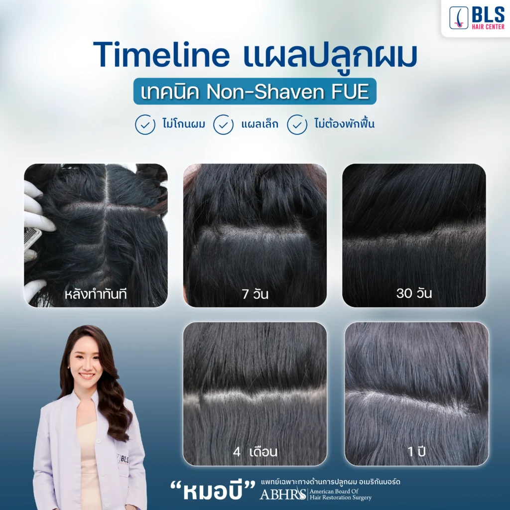 Timeline การเข้าที่ของแผลด้านหลังของเทคนิคปลูกผม Non-Shaven FUE 