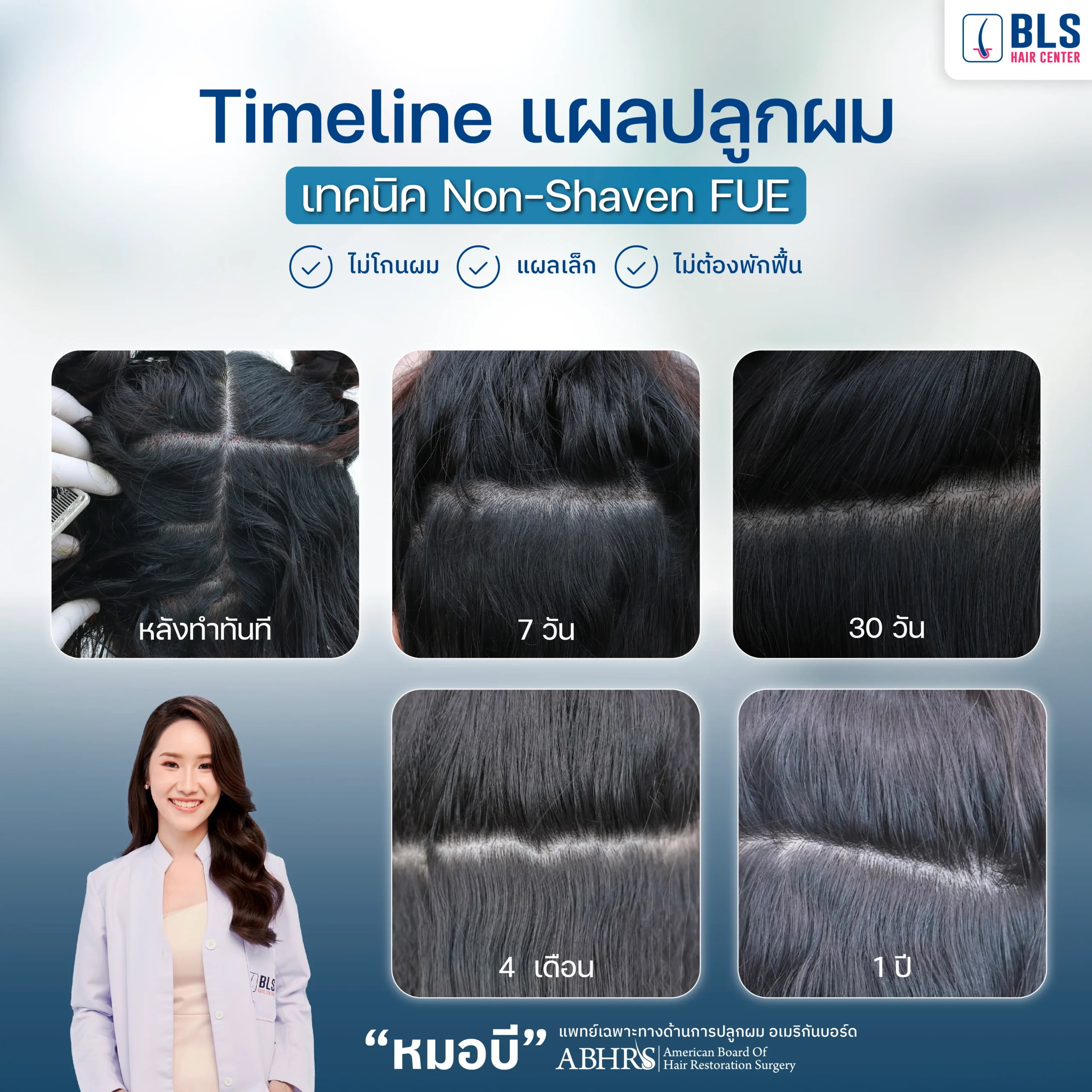 Timeline การเข้าที่ของแผลด้านหลังของเทคนิคปลูกผม Non-Shaven FUE