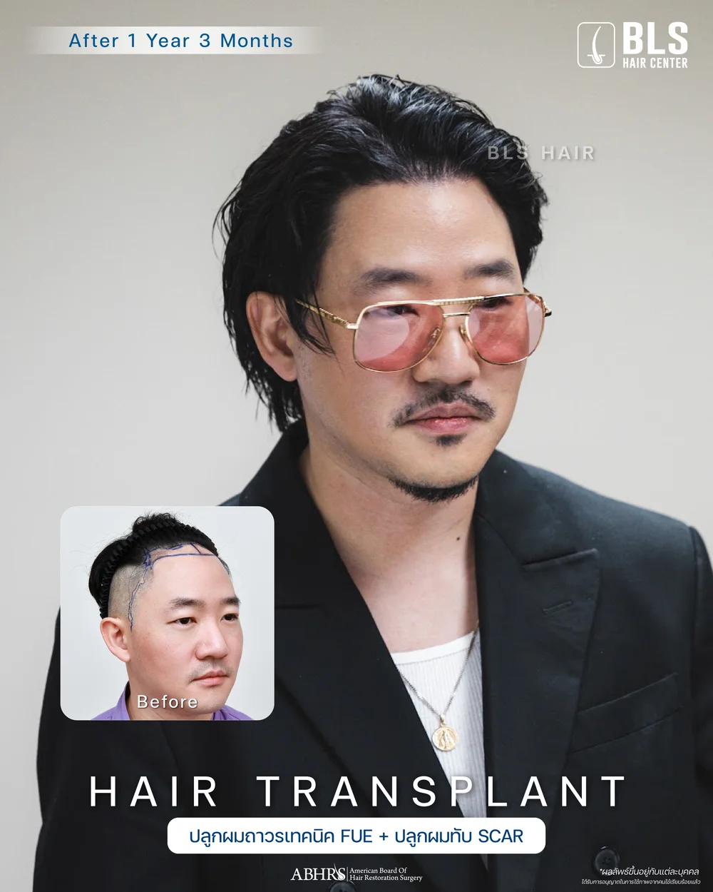 ผลลัพธ์หลังปลูกผมผู้ชาย เทคนิค FUE