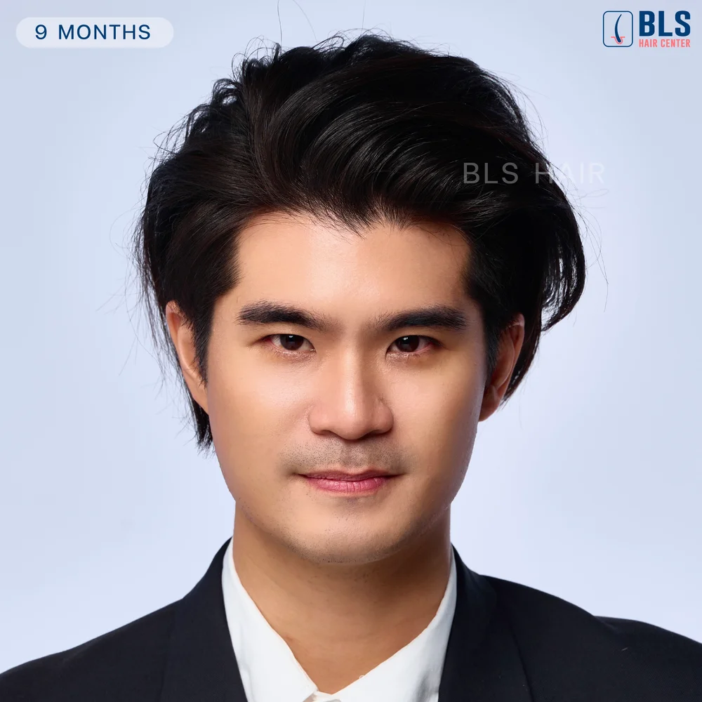 เปิด Timeline หลังปลูกผมผู้ชาย เทคนิค FUE