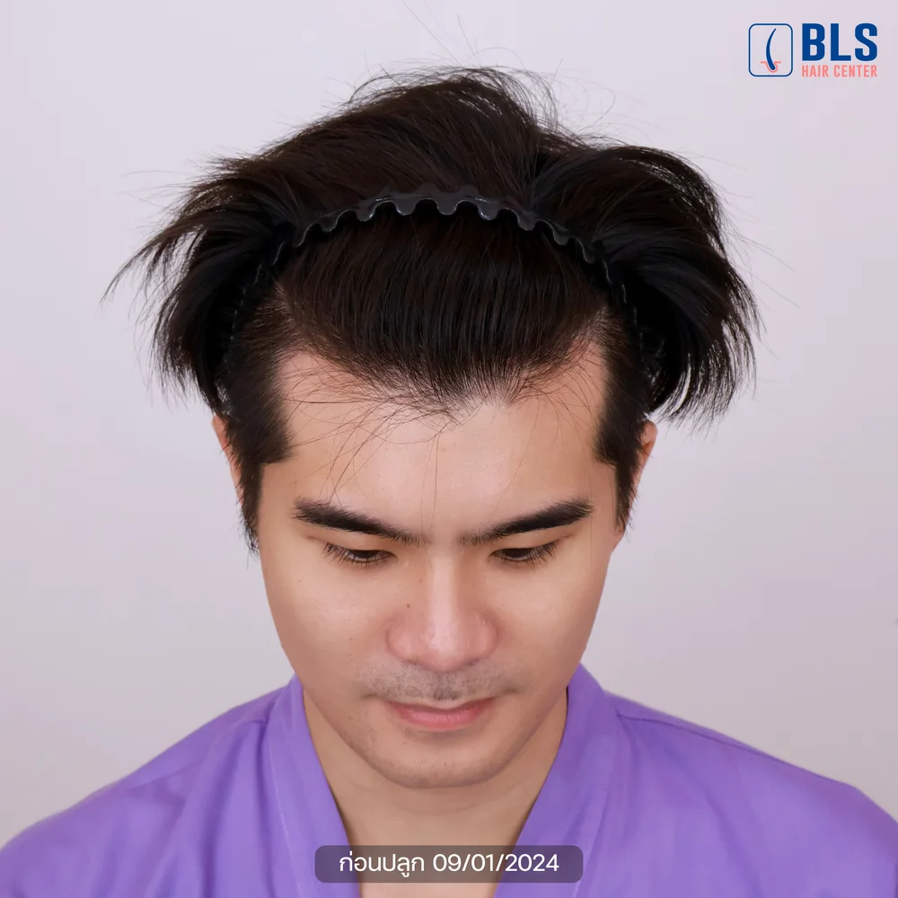 เปิด Timeline แต่ละช่วงหลังปลูกผม