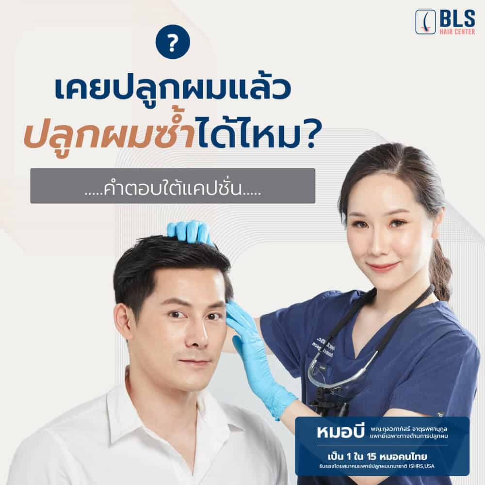 ปลูกผมอยู่ได้ถาวรไหม? และแนะนำ ปลูกผมที่ไหนดี ปี 2023 