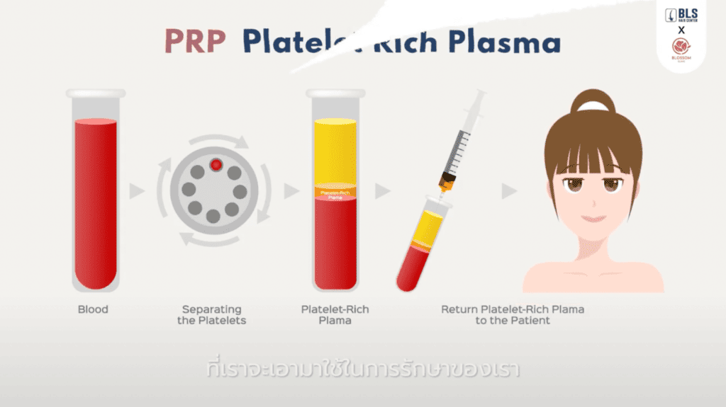 PRP (Platelet Rich Plasma)  คืออะไร ? 