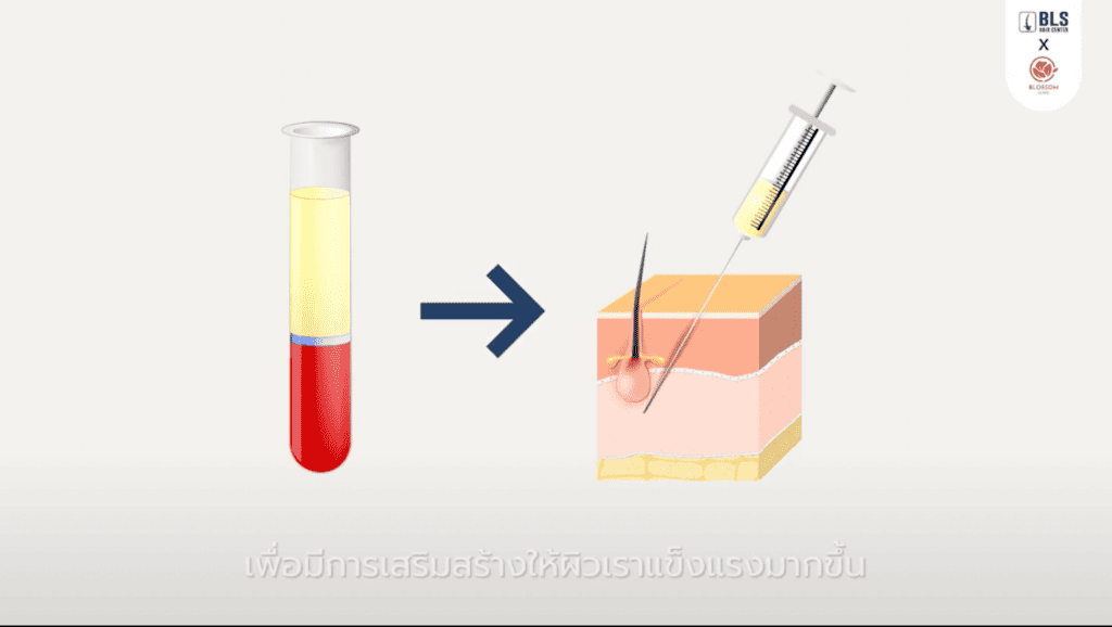 PRP ช่วยอะไรบ้าง? เพื่อแก้ ปัญหาเรื่องเส้นผม