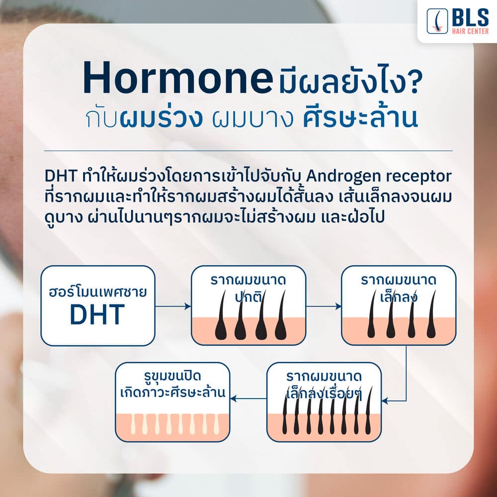 สาเหตุ หัวล้านกรรมพันธุ์