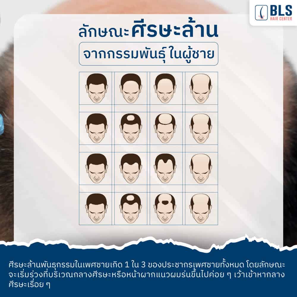 ลักษณะหัวล้านกรรมพันธุ์ในเพศชาย