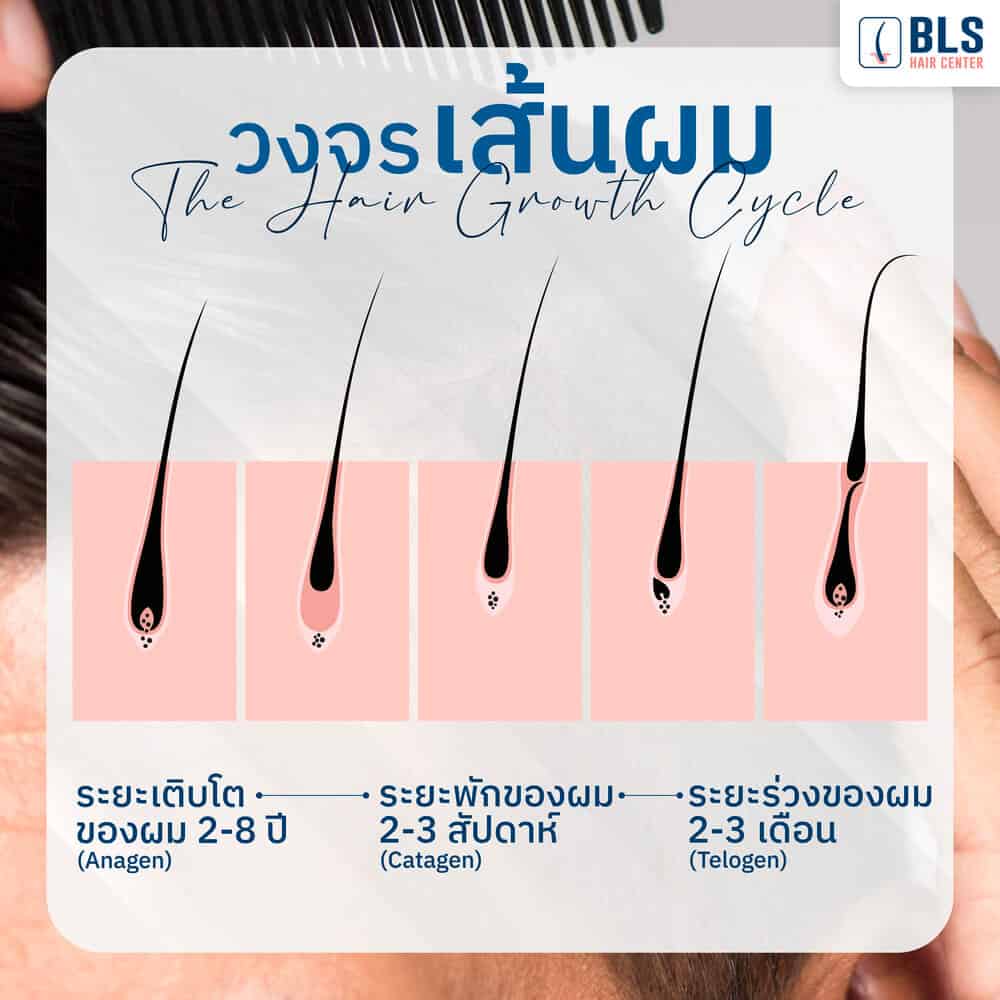 ศีรษะล้านจากกรรมพันธุ์ (Androgenetic alopecia) คืออะไร?