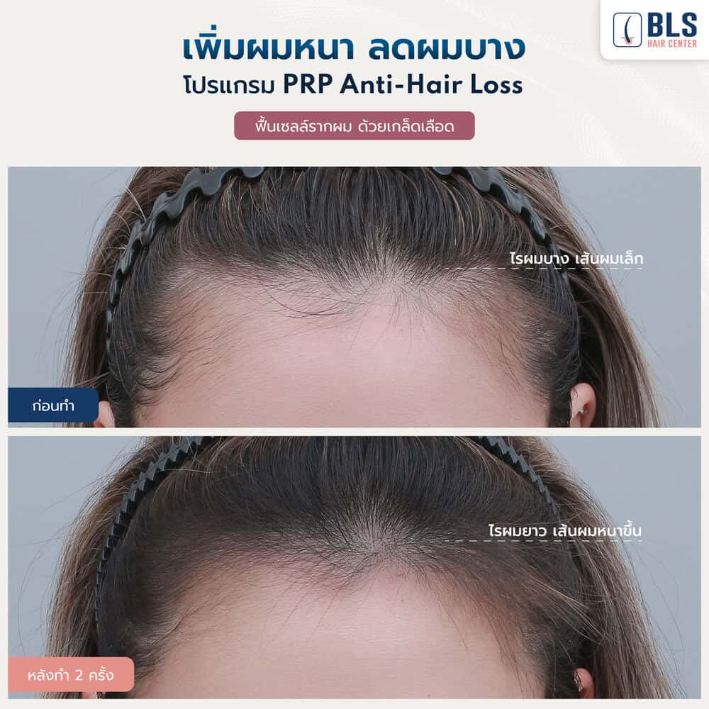 ฉีด PRP (Platelet Rich Plasma)