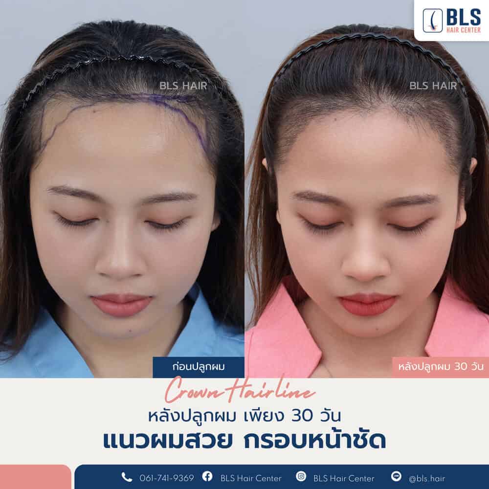 ปลูกผมผู้หญิง (Female Hairline)