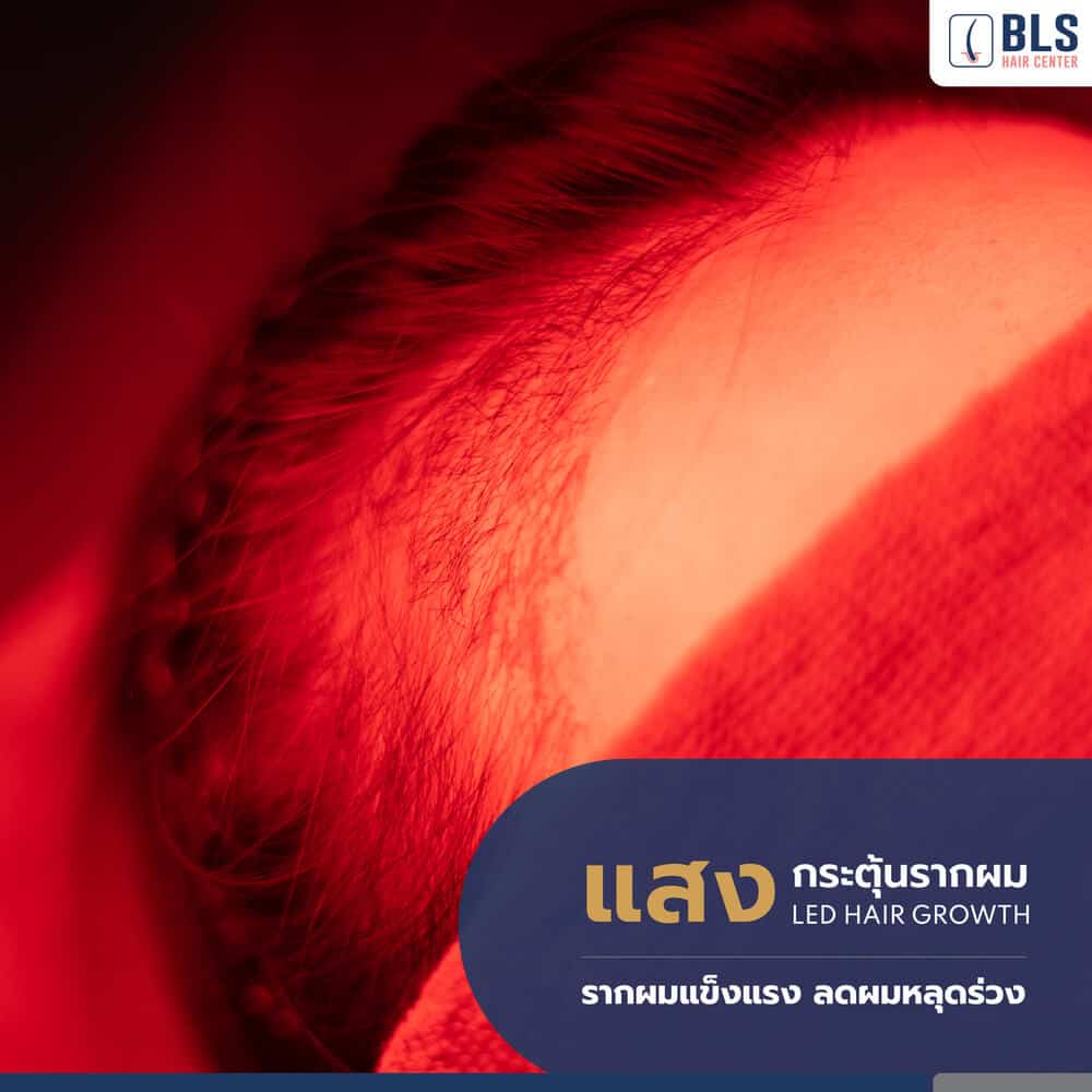 ฉายแสงกระตุ้นรากผม (LED Hair Growth)