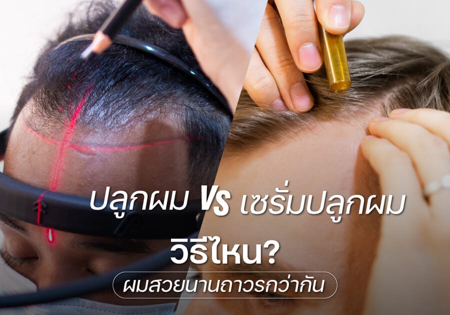 ผ่าตัดปลูกผม ดีกว่า เซรั่มปลูกผม ? ผมสวยนานถาวรจริงไหม?