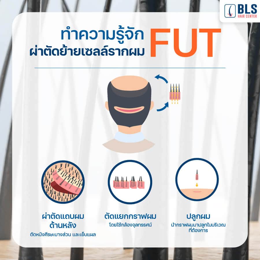 การผ่าตัดย้ายเซลล์รากผม FUT