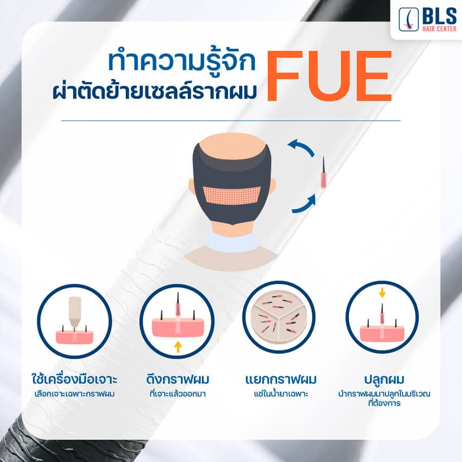 การผ่าตัดย้ายเซลล์รากผม FUE | ผ่าตัดปลูกผม