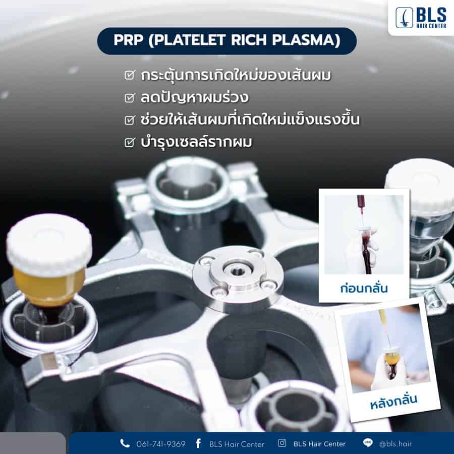 ฟื้นฟูรากผมด้วยการฉีดผม PRP | เพิ่มผมหน้า