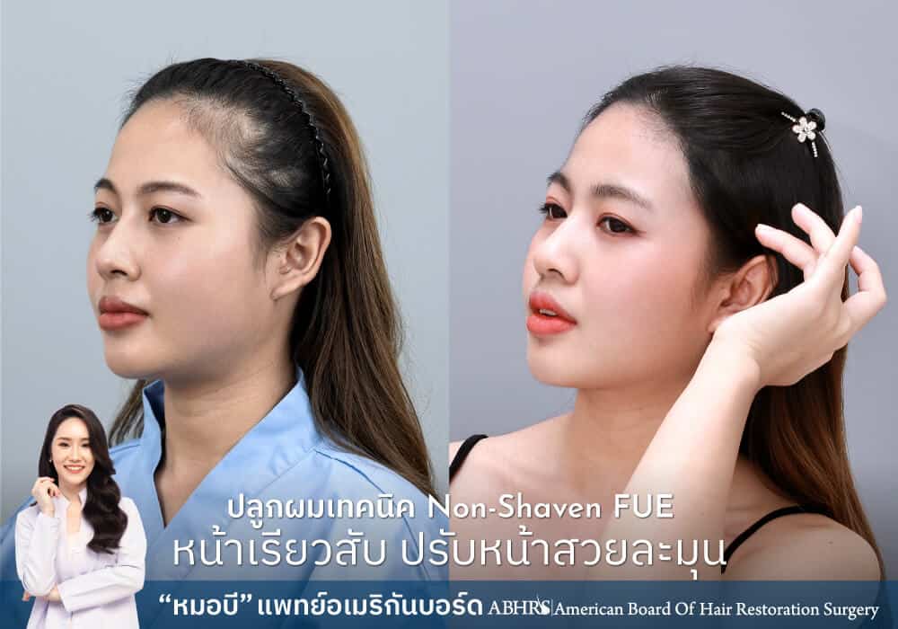 ปลูกผมผู้หญิง เทคนิค Non-Shaven FUE