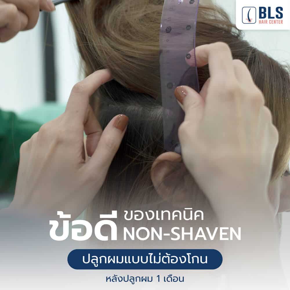 ข้อดีของเทคนิค Non-Shaven FUE ปลูกผมแบบไม่ต้องโกน