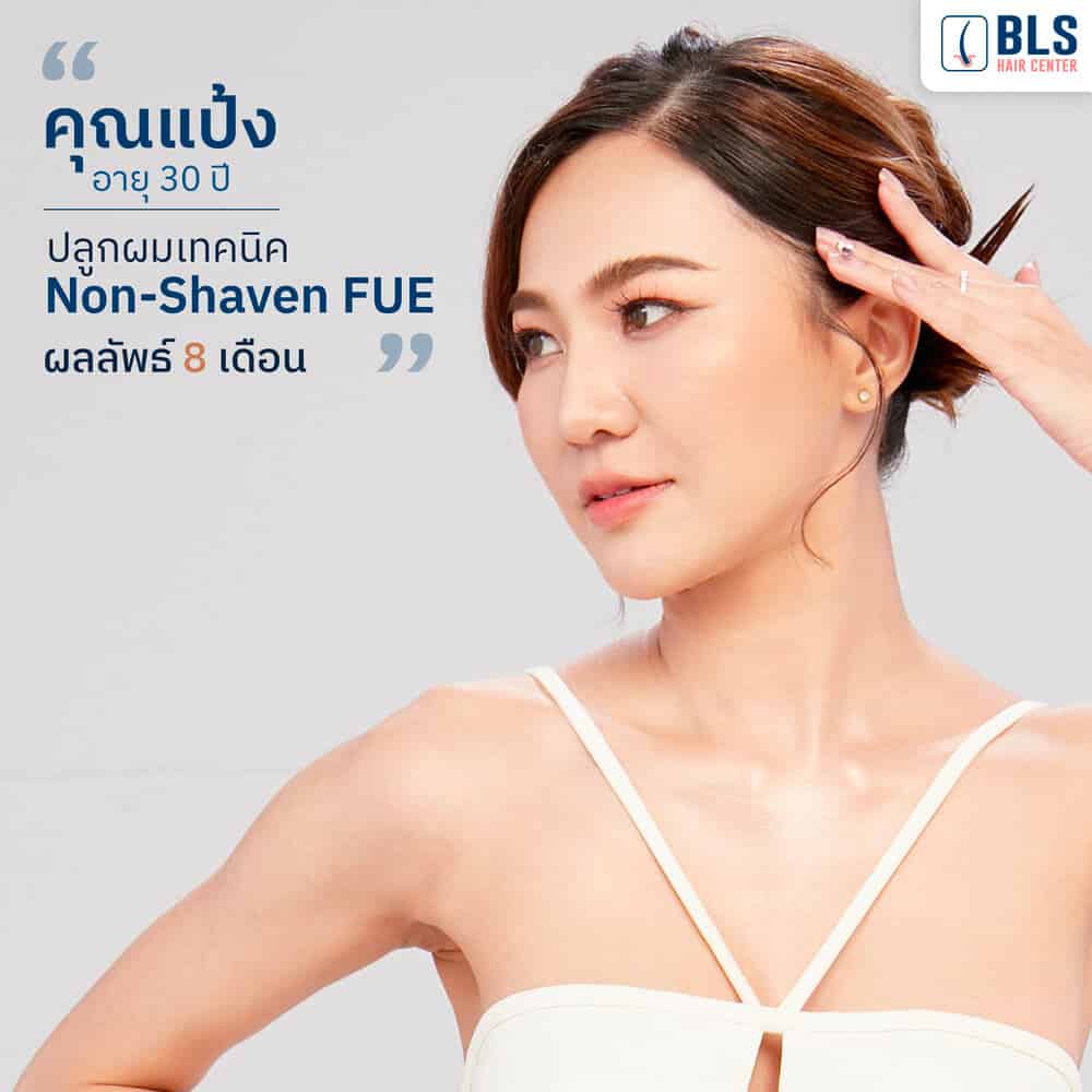 รีวิวเคสปลูกผมผู้หญิงสุดปัง ด้วยเทคนิค Non-Shaven FUE แบบไม่ต้องโกน