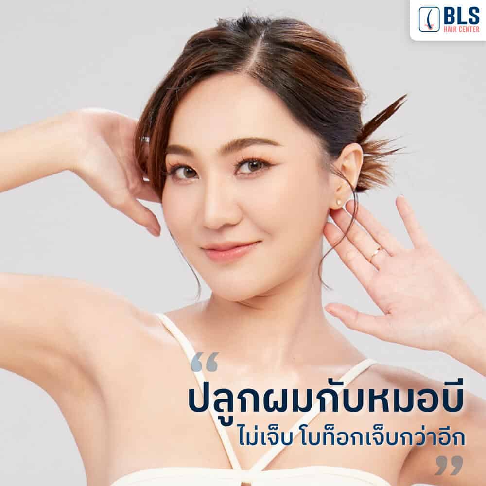 หมอบี ปลูกผม ด้วยเทคนิคเฉพาะ BLS ไม่เห็นแผล พักฟื้นน้อย ไม่รู้สึกเจ็บ | ปลูกผม FUE