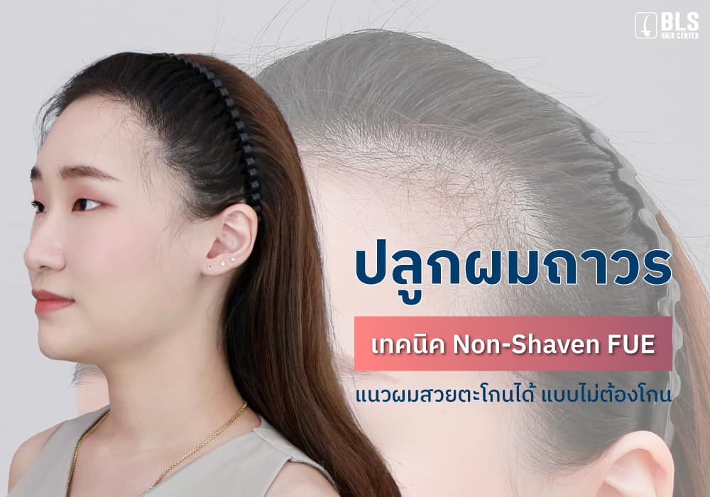 ปลูกผมถาวร เทคนิค Non-Shaven FUE แนวผมสวยตะโกนได้ แบบไม่ต้องโกน