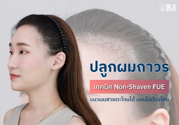 ปลูกผมถาวร เทคนิค Non-Shaven FUE แนวผมสวยตะโกนได้ แบบไม่ต้องโกน