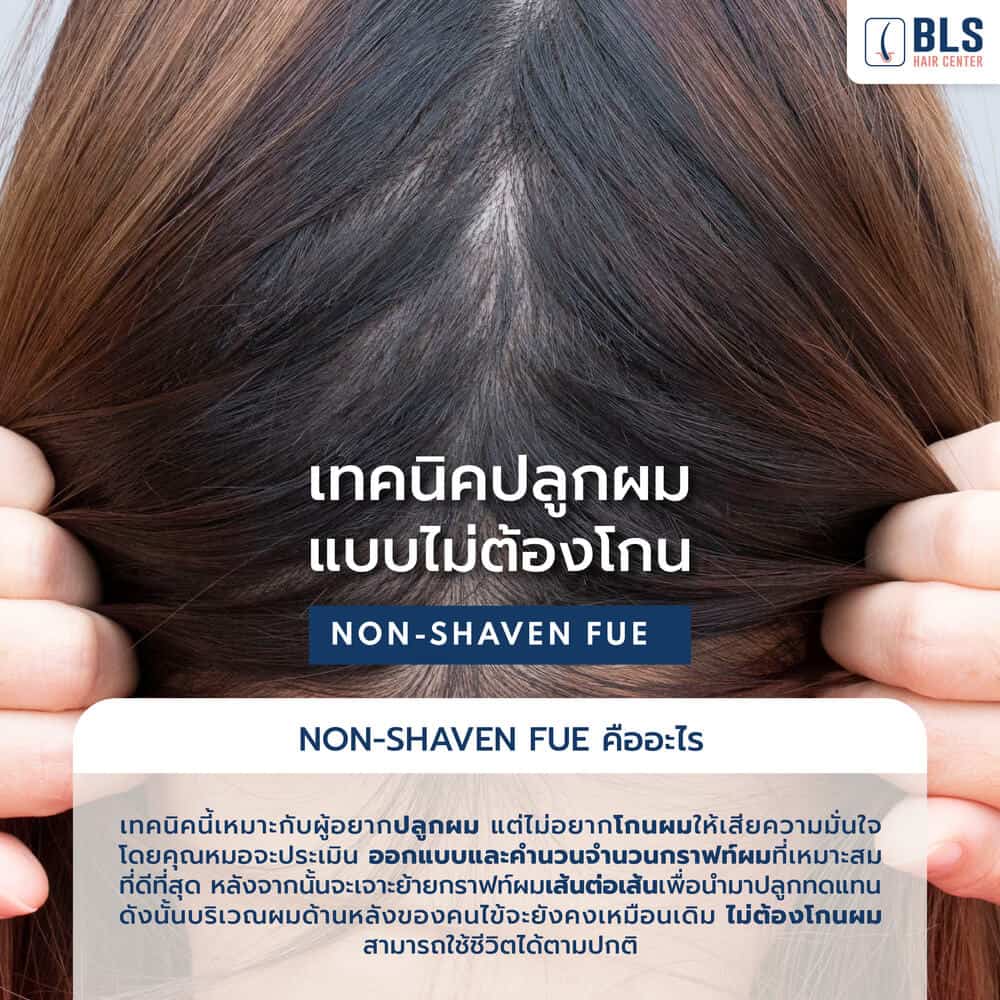 Non-Shaven FUE คืออะไร | ปลูกผม FUE