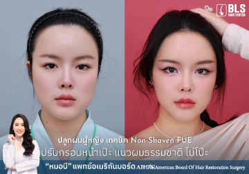 ปลูกผมผู้หญิง เทคนิค Non-Shaven FUE