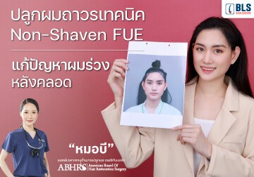 ปลูกผมถาวร เทคนิค Non-Shaven FUE แก้ปัญหาผมร่วง หลังคลอด