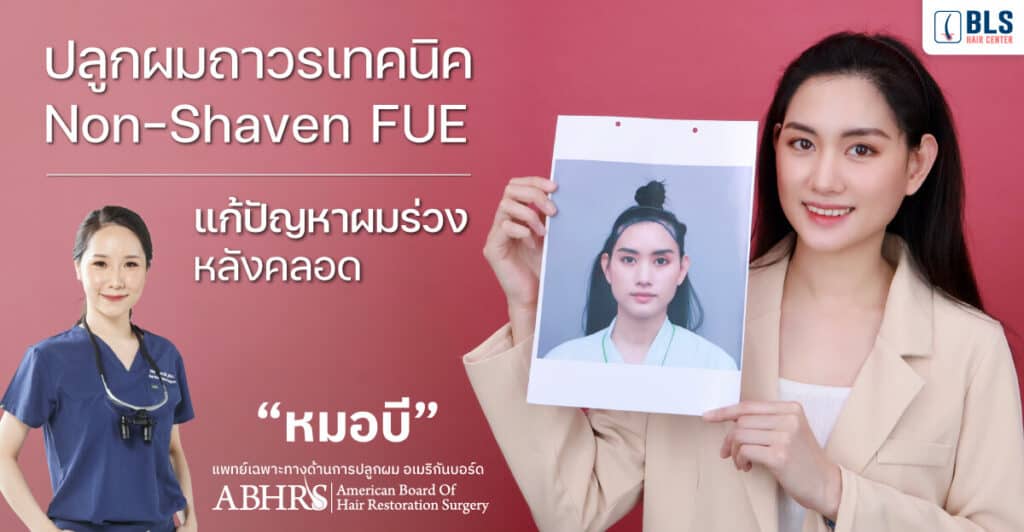 ปลูกผมถาวร เทคนิค Non-Shaven FUE แก้ปัญหาผมร่วง หลังคลอด