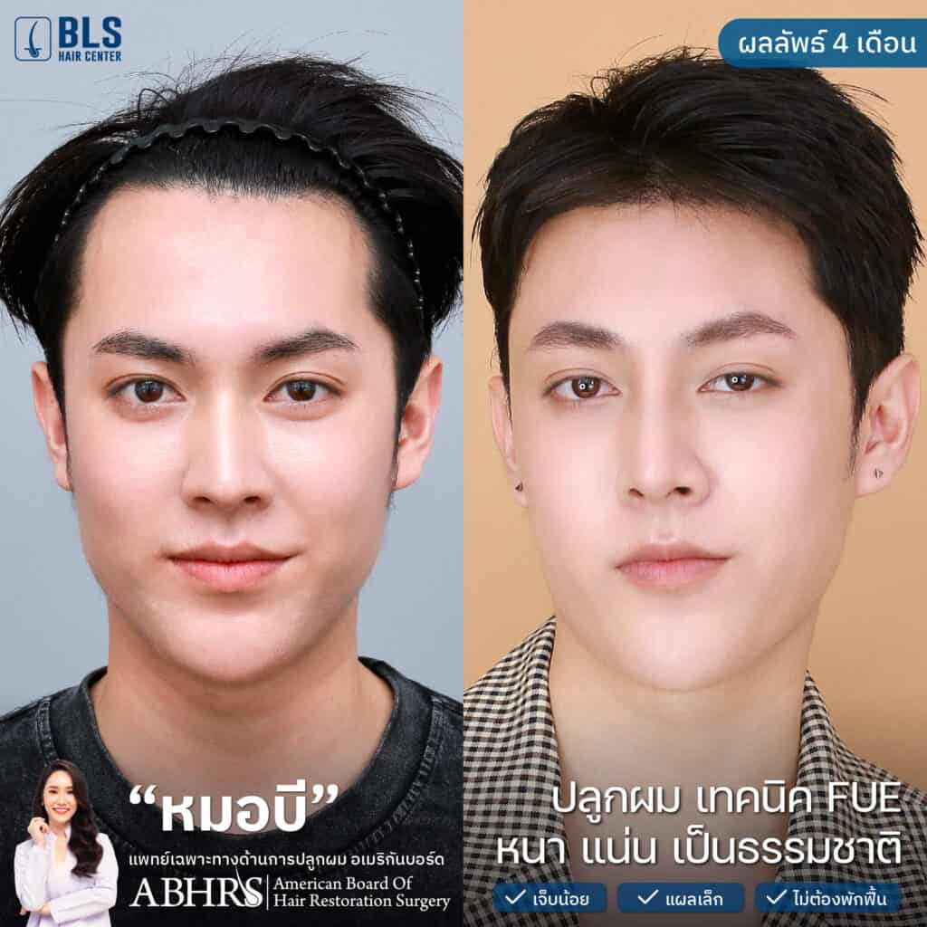 ชมเคสปลูกผม ผู้ชาย แก้ไขผมบาง หน้าผากกว้าง โดยหมอบี ที่ BLS Hair Center