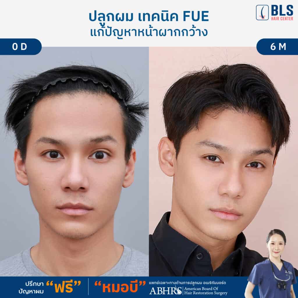 ชมเคสปลูกผม FUE รักษาผมบาง หน้าผากกว้าง ให้ ผมหนาขึ้น โดยหมอบี อเมริกันบอร์ด ที่ BLS Hair Center