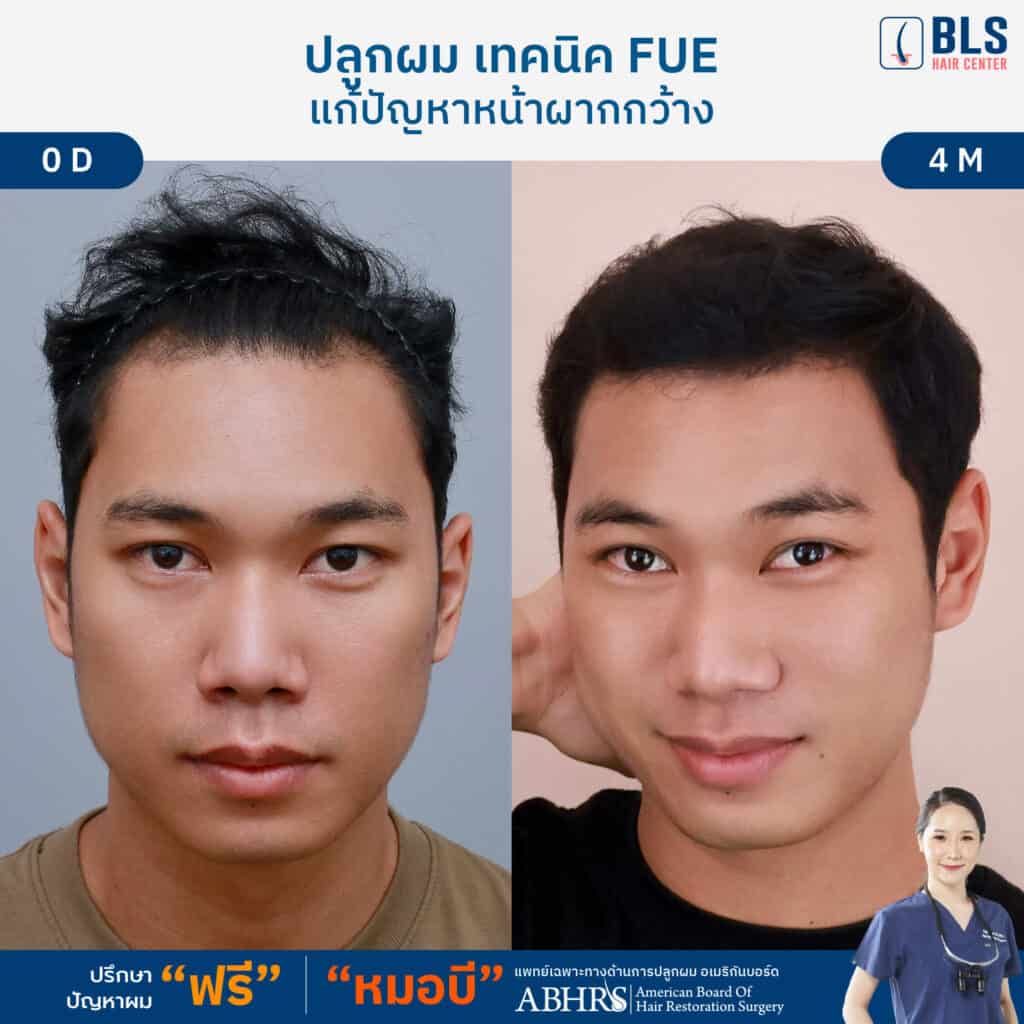 ชมเคสปลูกผม ผู้ชาย แก้ไขผมบาง หน้าผากกว้าง โดยหมอบี ที่ BLS Hair Center