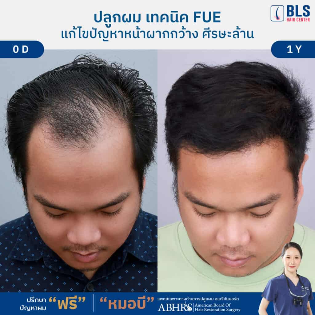 ชมเคสปลูกผม ผู้ชาย แก้ไขผมบาง หน้าผากกว้าง โดยหมอบี ที่ BLS Hair Center