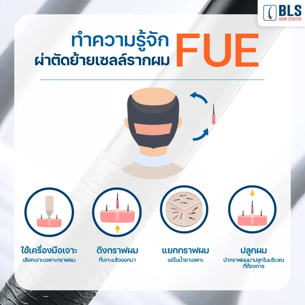  เทคนิคปลูกผมถาวร FUE 